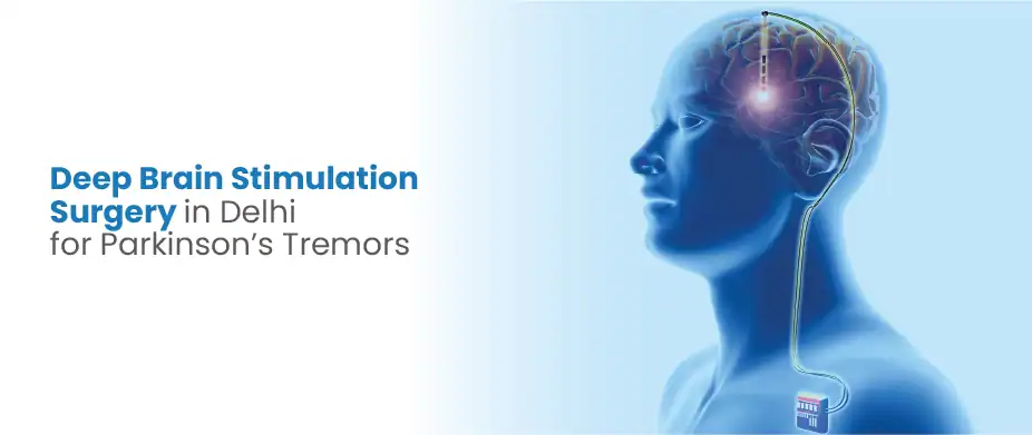 Deep Brain Stimulation Surgery in Delhi for Parkinson’s Tremors
